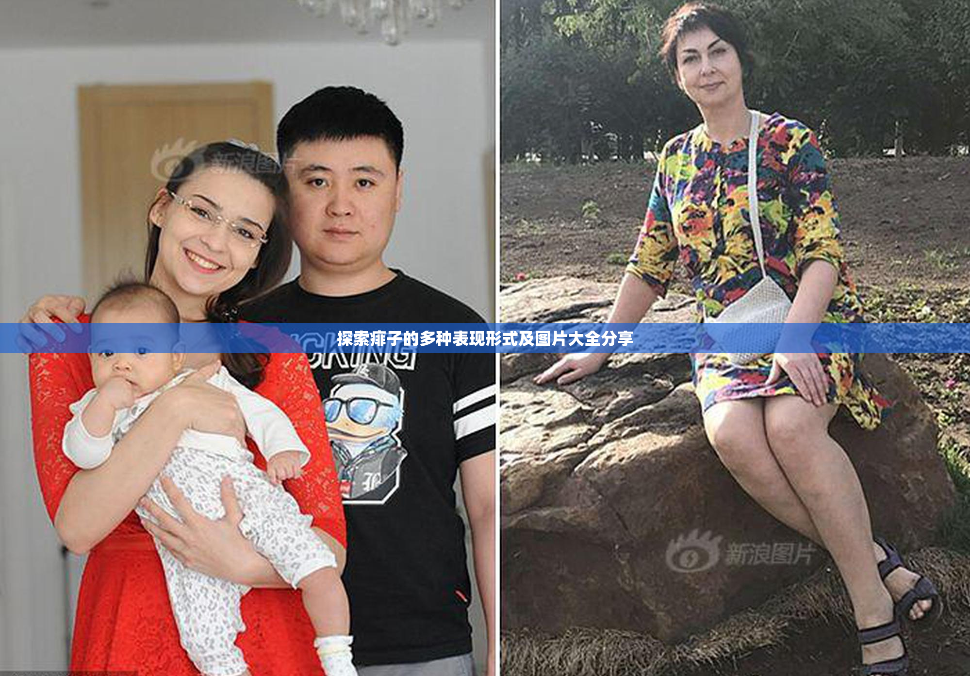 探索痱子的多种表现形式及图片大全分享